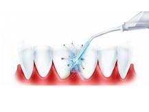 Oral irrigator: what to look for when choosing